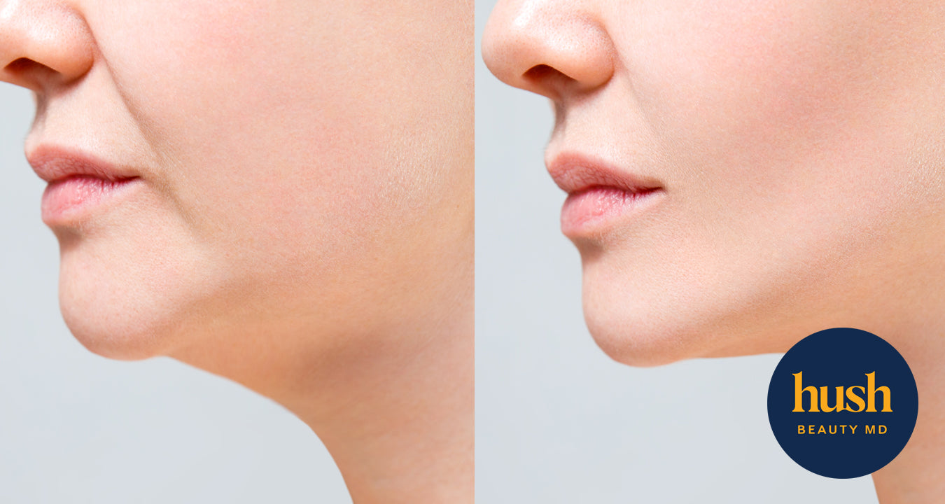 The Science Behind Submental Fat &The Benefits of Belkyra Treatment in Vancouver