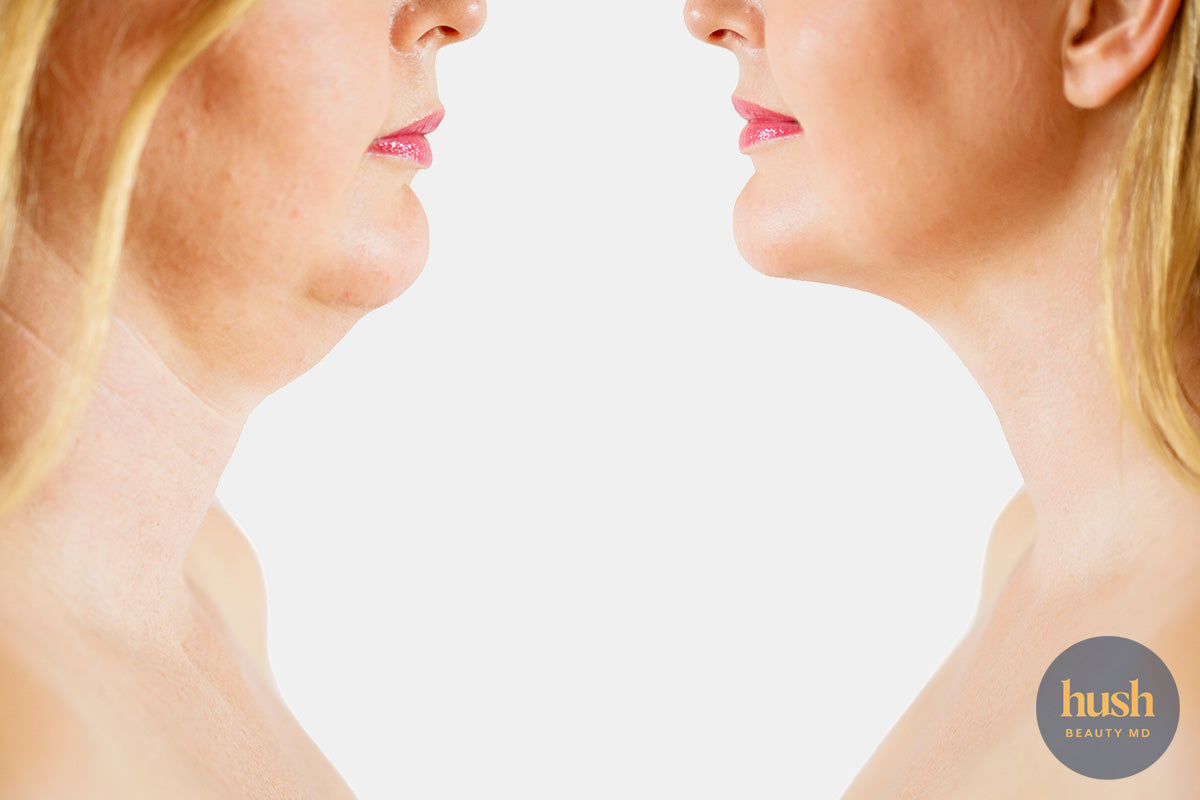 The Secret to Getting Rid of Double Chins: Introducing Belkyra Treatment