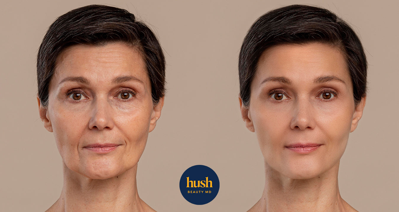 How the Morpheus8- Vancouver’s Top Choice for Skin Rejuvenation