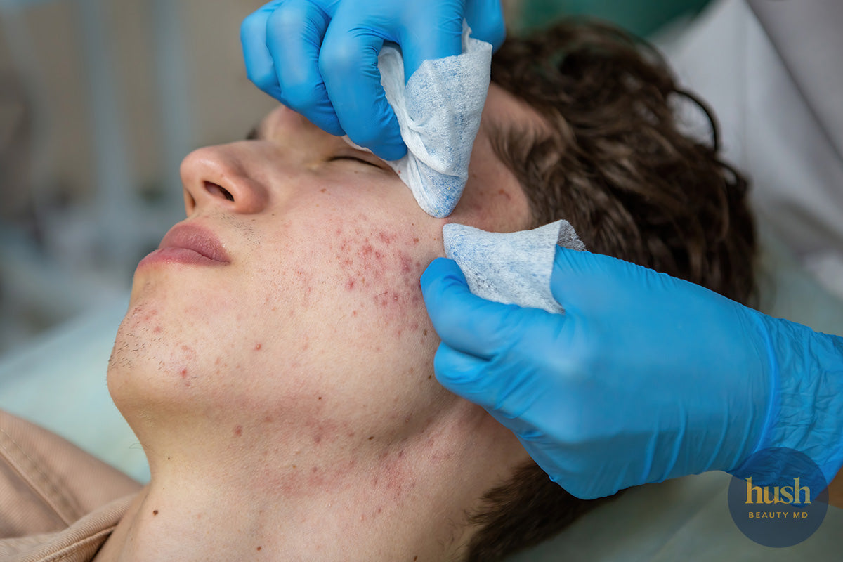 Unleash Your Radiance with Acne Scar Treatment in Vancouver