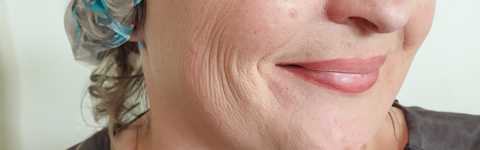 Deep Nasolabial Folds (Smile Lines) – Hush Beauty MD