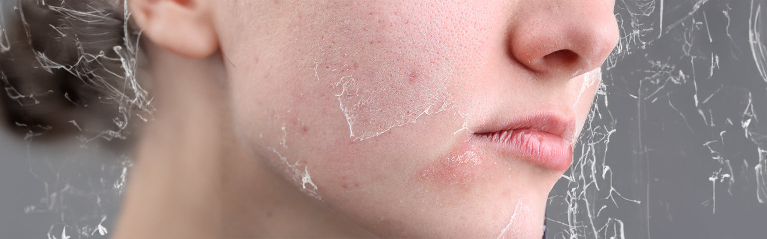 Dull Skin Treatment Vancouver BC - Brighten Up Your Dull Skin | Hush ...