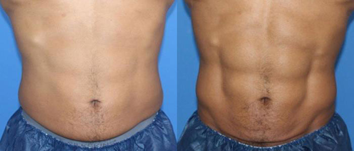 truSculpt iD body contouring treatment at Hush Beauty MD