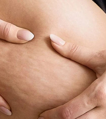 Cellulite