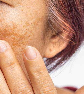 Pigmentation