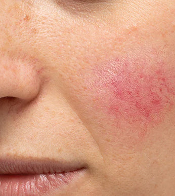 Rosacea