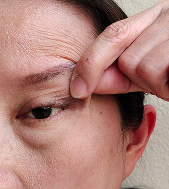 Sagging Brows & Eyelids