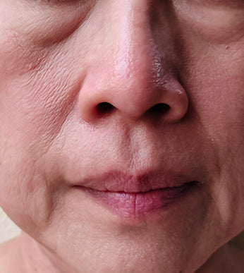 Skin Laxity & Sagginess