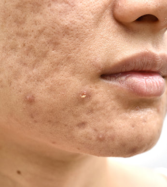 Acne Scars