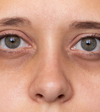 Dark Circles & Hollows