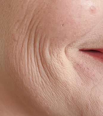 Nasolabial Folds