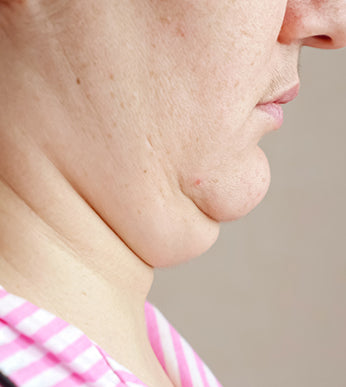 Double Chin