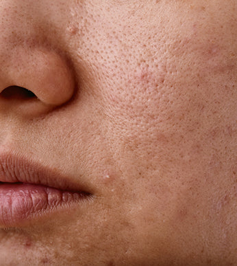 Enlarged Pores