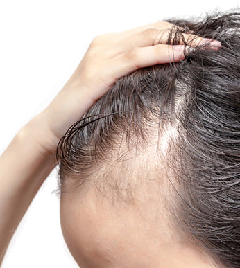 Hair Loss