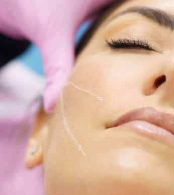 Threadlift