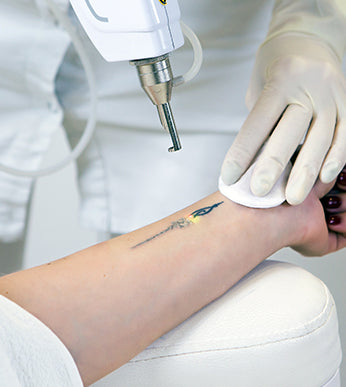 Tattoo Removal